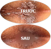 sùi mào gà