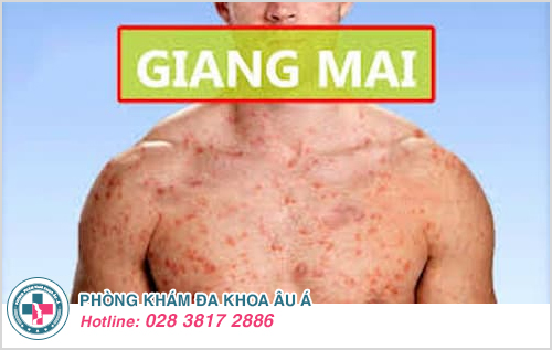 Bệnh giang mai là gì? Bệnh giang mai là gì?