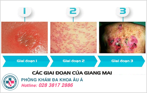 Triệu chứng bệnh giang mai Triệu chứng bệnh giang mai