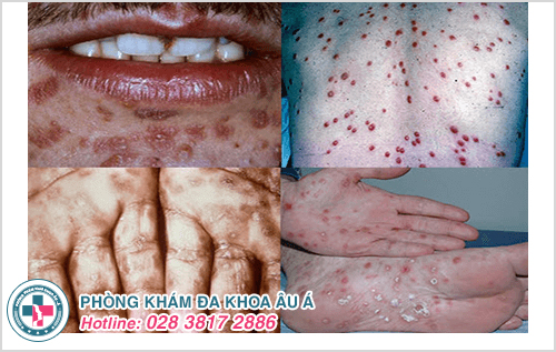 Bệnh giang mai là gì? Bệnh giang mai là gì?