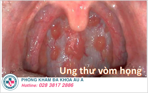 Ung thư vòm họng biến chứng nguy hiểm Ung thư vòm họng biến chứng nguy hiểm