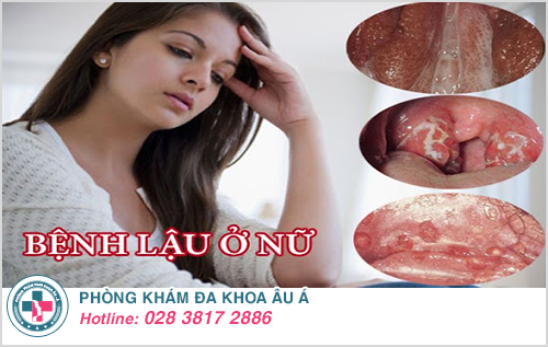 Dấu hiệu nhận biết bệnh lậu ở nữ giới Dấu hiệu nhận biết bệnh lậu ở nữ giới
