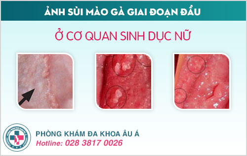 Ảnh sùi mào gà giai đoạn đầu