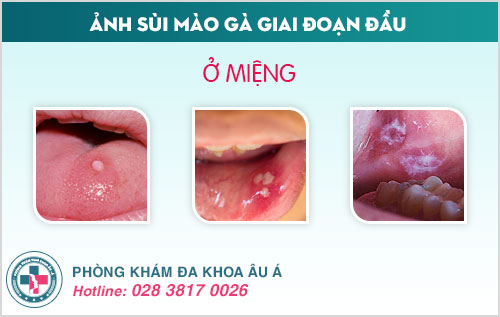Ảnh sùi mào gà giai đoạn đầu