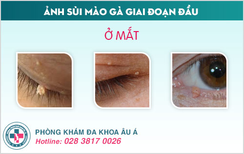 Ảnh sùi mào gà giai đoạn đầu