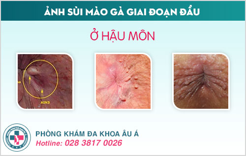 Ảnh sùi mào gà giai đoạn đầu