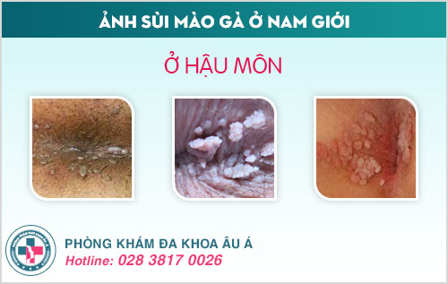 Ảnh sùi mào gà ở nam giới