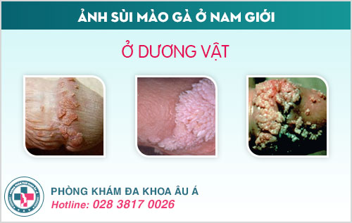 Ảnh sùi mào gà ở nam giới