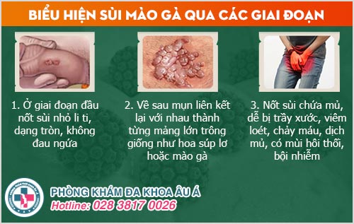 Bị sùi mào gà có chữa được không