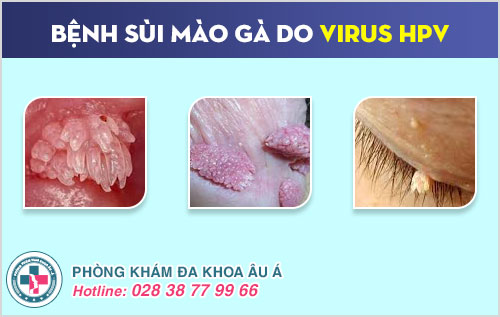 điều trị virus HPV