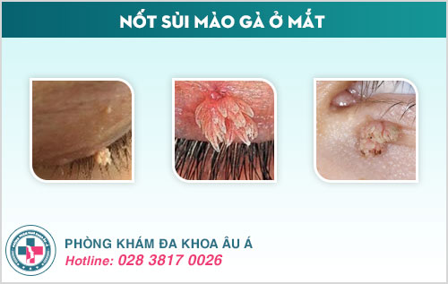 Sùi mào gà mọc ở đâu