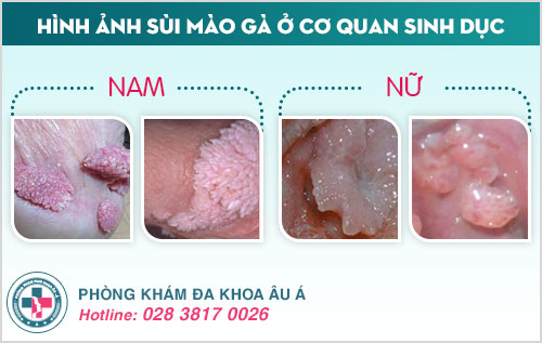 Sùi mào gà mọc ở đâu