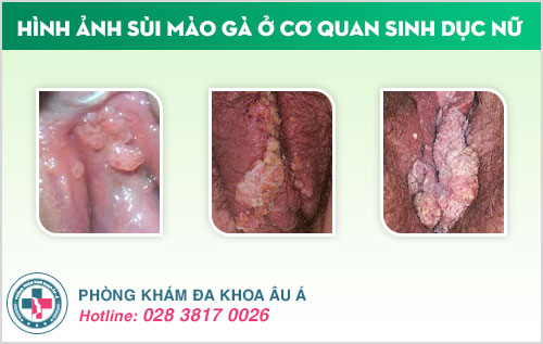 Sùi mào gà ở bộ phận sinh dục nữ
