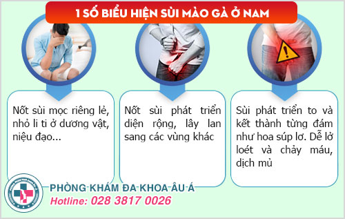 Sùi mào gà ở nam