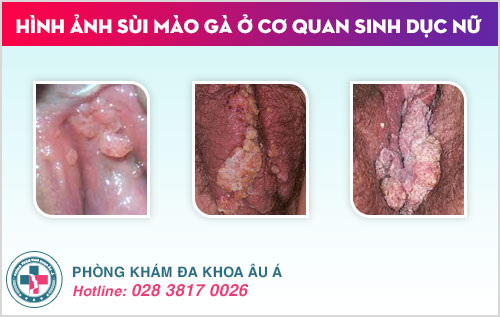 sùi mào gà ở nữ
