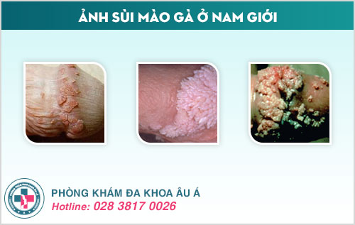 Tại sao bị sùi mào gà ở nam