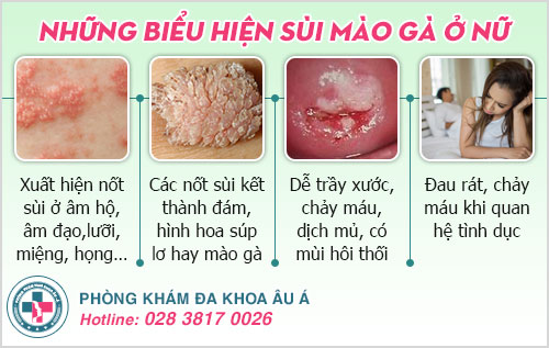 trị sùi mào gà ở nữ