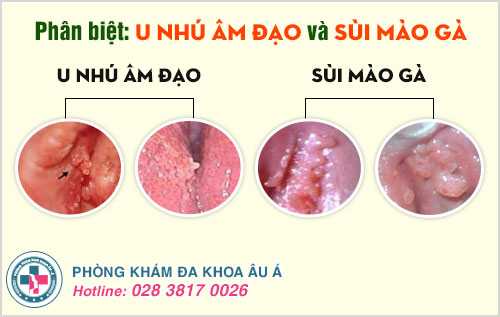 U nhú âm đạo