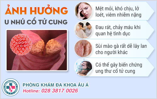 U nhú cổ tử cung
