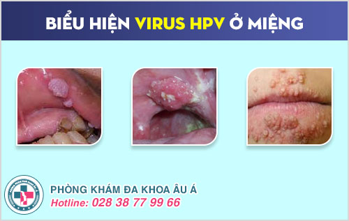 virus HPV ở miệng