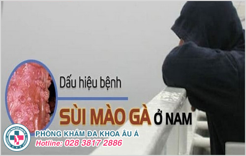 Dấu Hiệu Nhận Biết Sùi Mào Gà Ở Nam Dấu Hiệu Nhận Biết Sùi Mào Gà Ở Nam