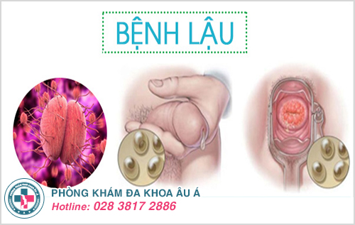 Bệnh lậu là gì? Bệnh lậu là gì?