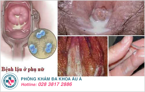 Bệnh lậu ở nữ giới giai đoạn mãn tính Bệnh lậu ở nữ giới giai đoạn mãn tính
