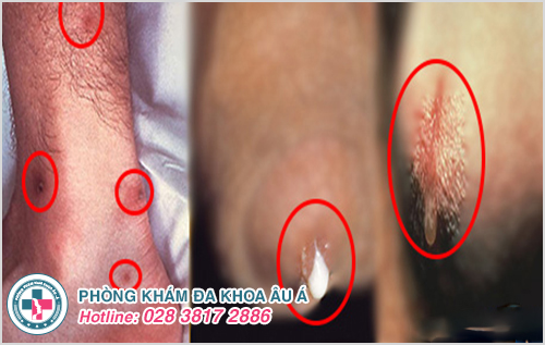 Hình ảnh bệnh lậu nam giới ở giai đoạn cấp tính Hình ảnh bệnh lậu nam giới ở giai đoạn cấp tính
