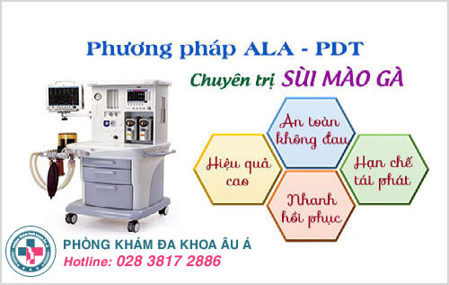 Phương pháp ALA - PDT điều trị dứt điểm bệnh sùi mào gà ở miệng và giúp tăng hệ miễn dịch cho cơ thể Phương pháp ALA - PDT điều trị dứt điểm bệnh sùi mào gà ở miệng và giúp tăng hệ miễn dịch cho cơ thể