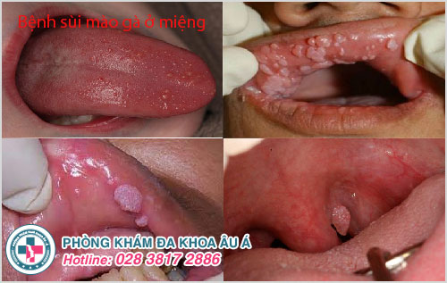 Biểu hiện đặc trưng của bệnh sùi mào gà ở miệng hình thành những nốt mụn thịt Biểu hiện đặc trưng của bệnh sùi mào gà ở miệng hình thành những nốt mụn thịt