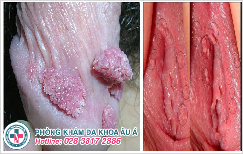 Chi phí đốt sùi mào gà phụ thuộc vào thể trạng bệnh sùi mào gà nặng nhẹ của mỗi bệnh nhân Chi phí đốt sùi mào gà phụ thuộc vào thể trạng bệnh sùi mào gà nặng nhẹ của mỗi bệnh nhân